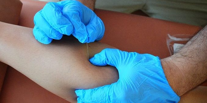 dryneedling-678×678