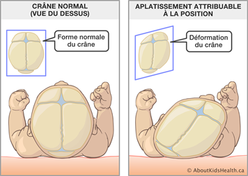 Positional_plagiocephaly_MED_ILL_fr