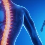 scoliose
